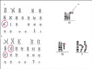 8 Kromozom Bozukluğu Hastalıkları